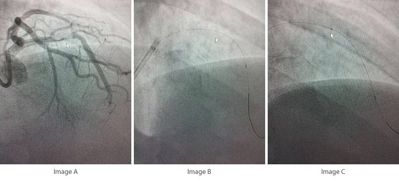 primary-angioplasty-step1-3