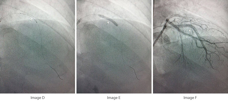 primary-angioplasty-step4-6